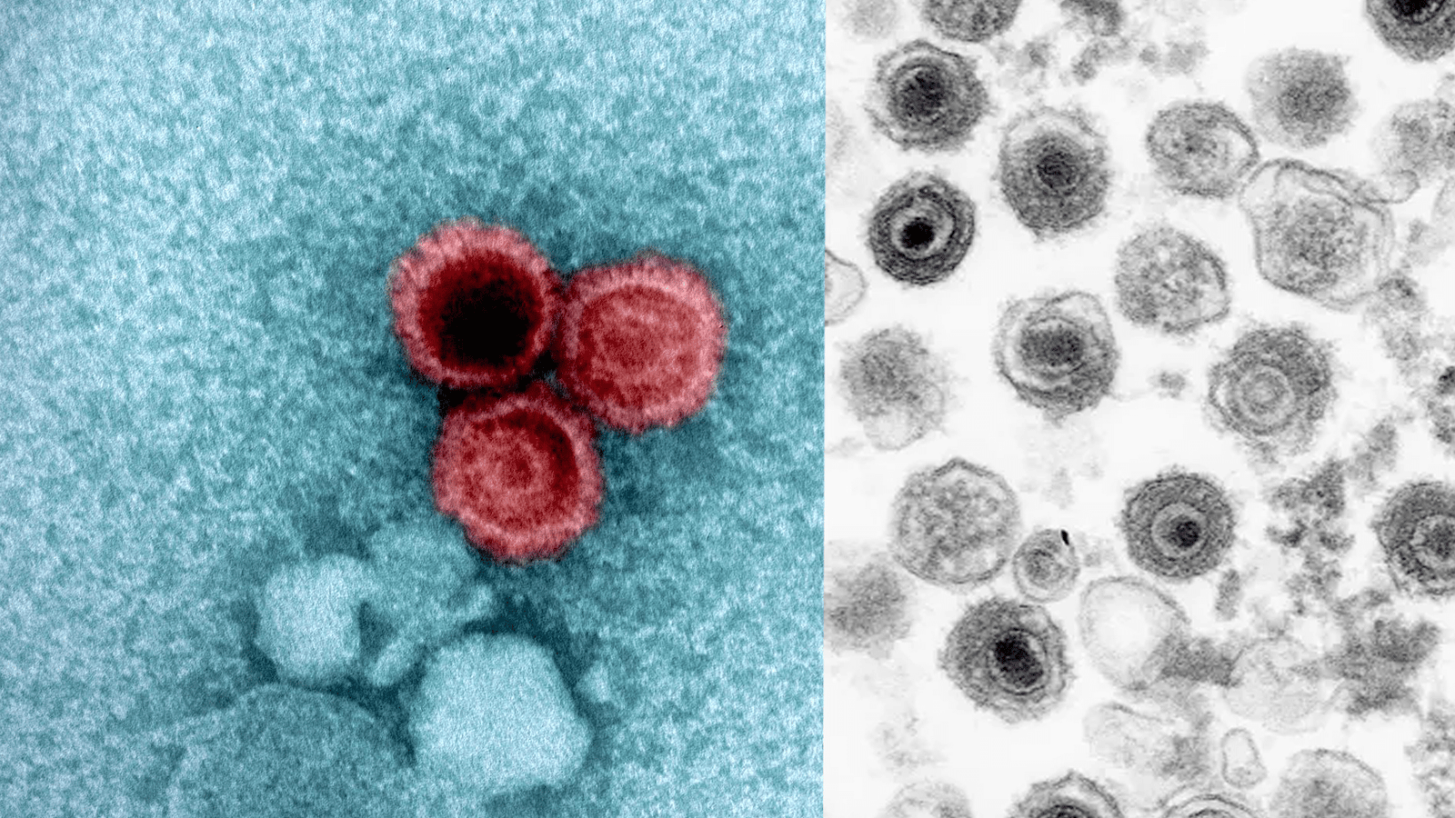 Scientists Develop New Antibodies Against Epstein-Barr Virus Affecting 95% of Adults Scientists Develop New Antibodies Against Epstein-Barr Virus Affecting 95% of Adults